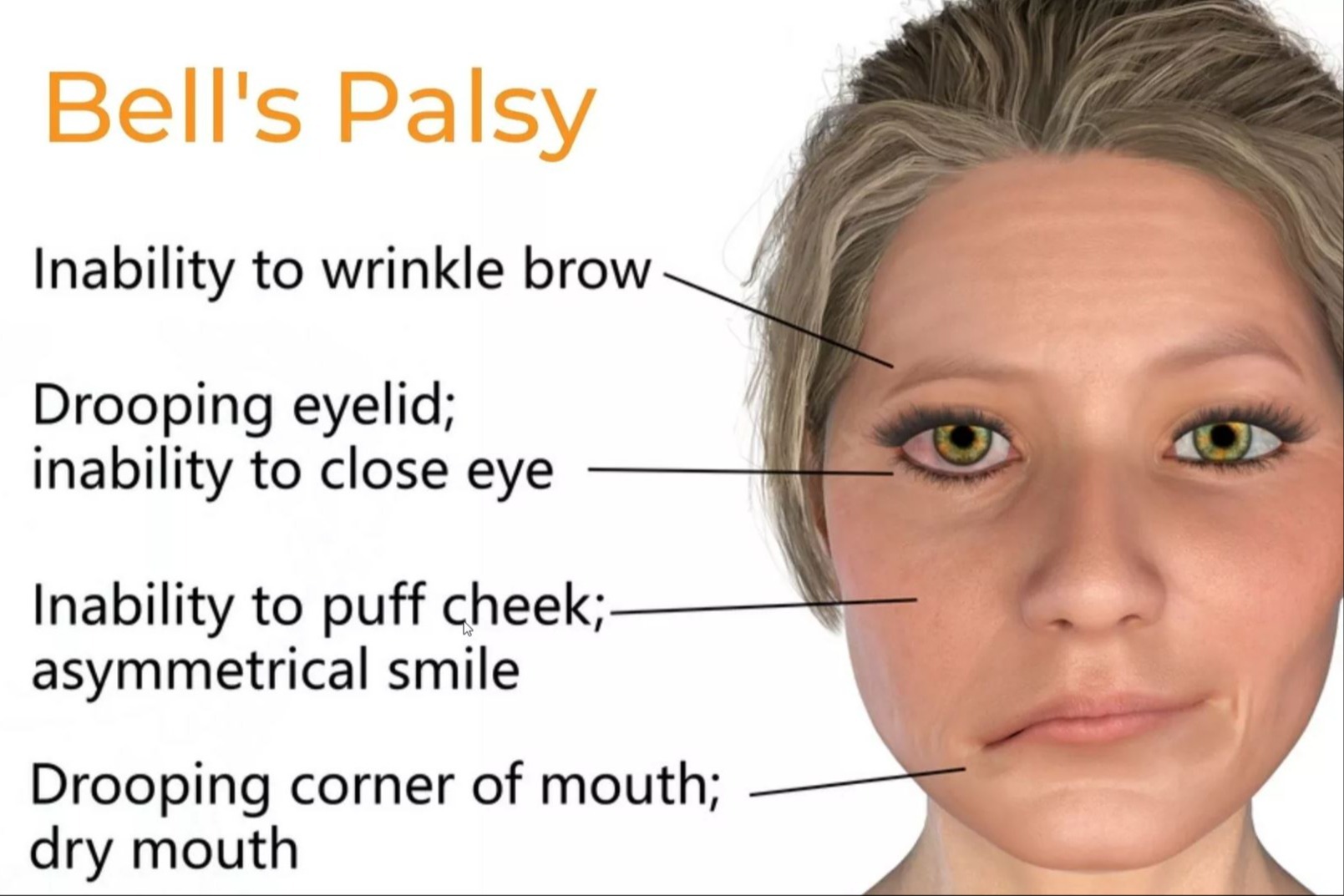 Bell's Palsy adalah kondisi yang menyebabkan kelumpuhan mendadak pada satu sisi wajah (unilateral) akibat gangguan saraf wajah (nervus facialis). Penanganan Bell's palsy  dengan akupunktur adalah salah satu metode yang sering digunakan untuk membantu memulihkan fungsi otot wajah.