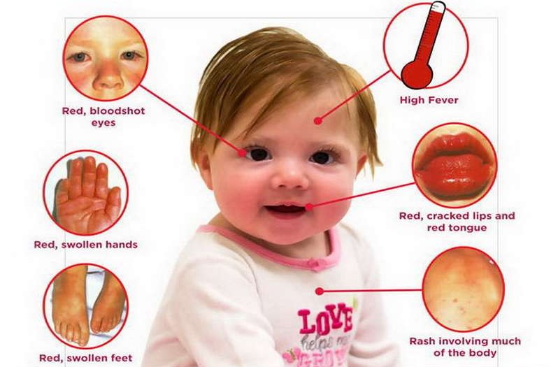 Penyakit Kawasaki terutama menyerang anak-anak di bawah usia lima tahun yang menyebabkan peradangan pada dinding arteri di seluruh tubuh termasuk arteri koroner